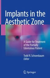 Implants in the Aesthetic Zone : A Guide for Treatment of the Partially Edentulous Patient