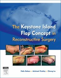 The Keystone Island Flap Concept in Reconstructive Surgery