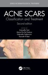 Acne Scars : Classification and Treatment, Second Edition