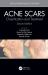 Acne Scars : Classification and Treatment, Second Edition