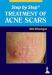 Step by Step: Treatment of Acne Scars