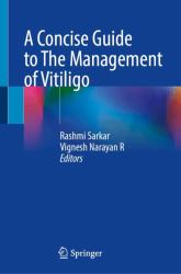 A Concise Guide to Management of Vitiligo