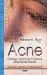 Acne : Etiology, Treatment Options and Social Effects