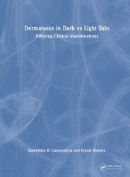 Dermatoses in Dark vs Light Skin : Differing Clinical Manifestations