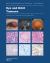 Eye and Orbit Tumours : WHO Classification of Tumours